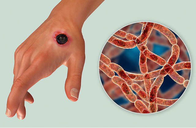 Bộ Y tế cập nhật thông tin mới nhất về tình hình dịch bệnh than trên người
